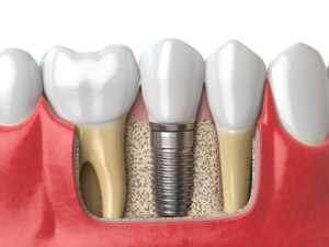 cirurgia oral