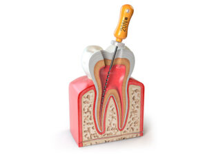 endodontia