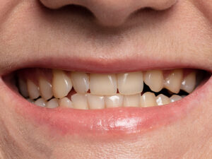 dentes amarelados