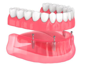 prótese dentária