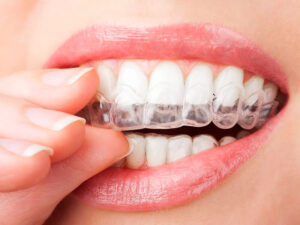 Clareamento dental